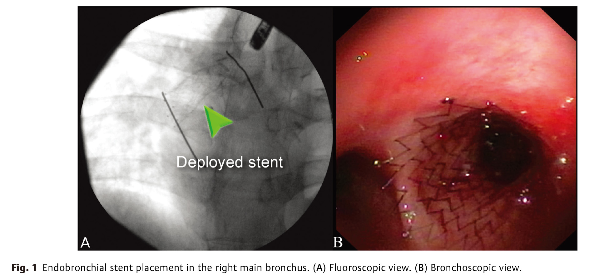 Long-Term Success of Metal Endobronchial-2.jpg