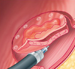 Endoscopic intermuscular dissection.jpg