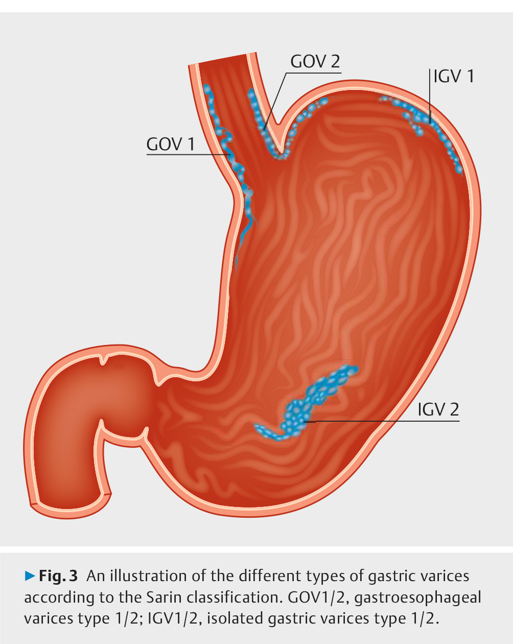 Endoscopic diagnosis and management.jpg